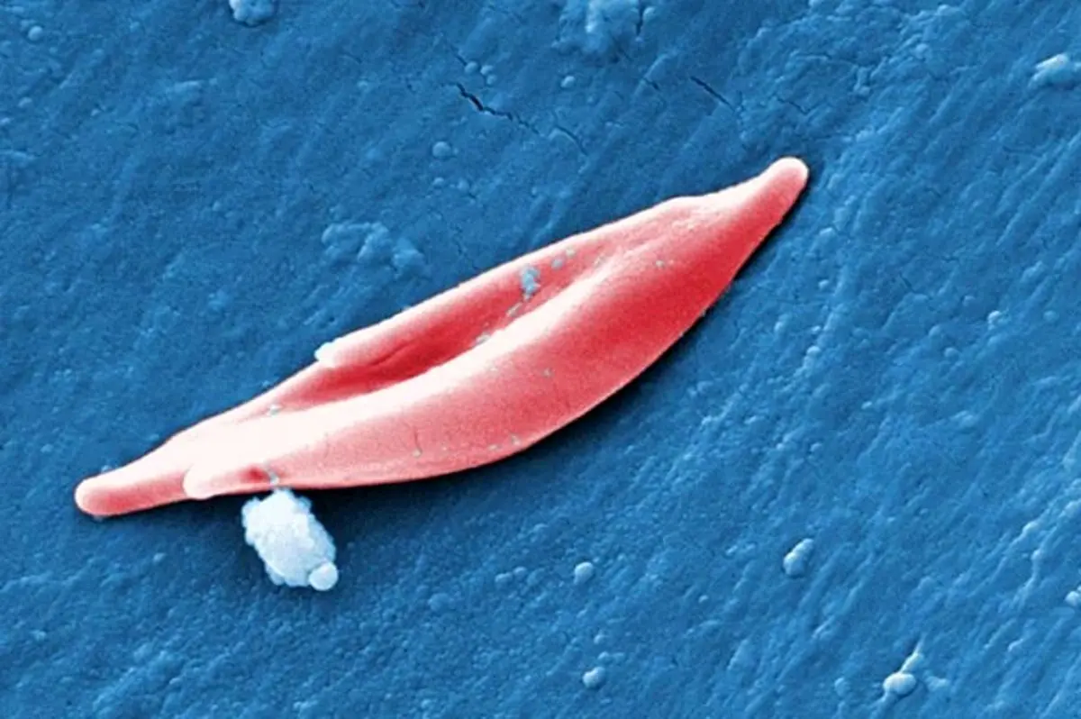 آمریکا برای اولین‌بار ژن‌درمانی با روش CRISPR برای کم‌خونی داسی‌شکل را تأیید کرد