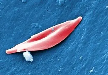 آمریکا برای اولین‌بار ژن‌درمانی با روش CRISPR برای کم‌خونی داسی‌شکل را تأیید کرد