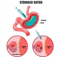 تزریق بوتاکس معده: روشی نوین برای لاغری و درمان اضافه وزن