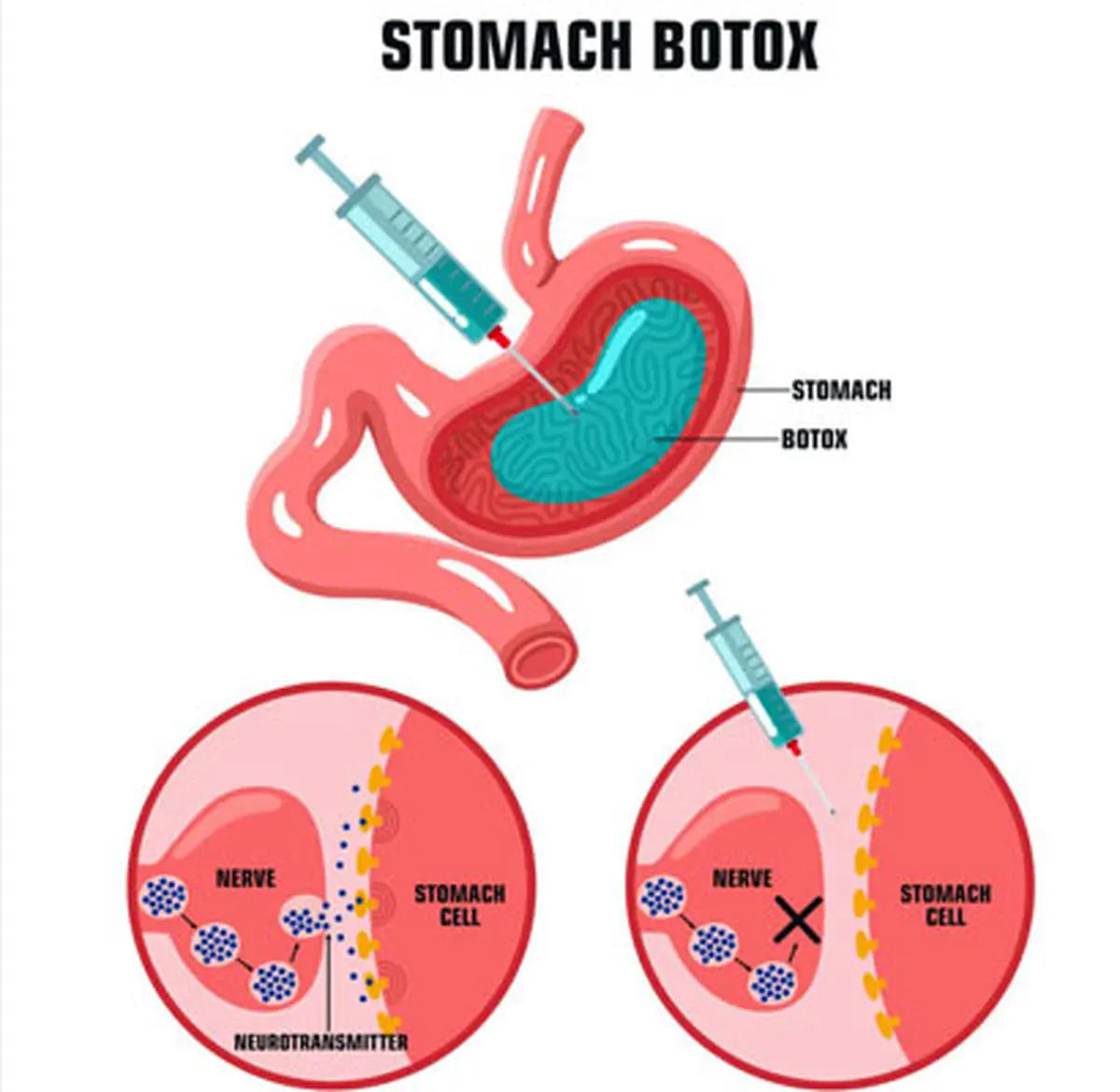 تزریق بوتاکس معده: روشی نوین برای لاغری و درمان اضافه وزن