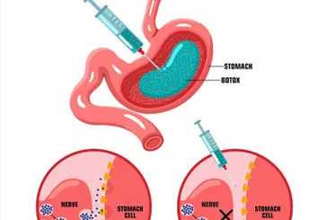 تزریق بوتاکس معده: روشی نوین برای لاغری و درمان اضافه وزن