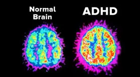 تحقیق جدید: اختلال ADHD خیلی بیشتر از تصورات ما در بزرگسالان شایع است
