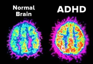 تحقیق جدید: اختلال ADHD خیلی بیشتر از تصورات ما در بزرگسالان شایع است