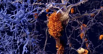 ارتباط بین متابولیسم و بی خوابی در بیماران مبتلا به آلزایمر