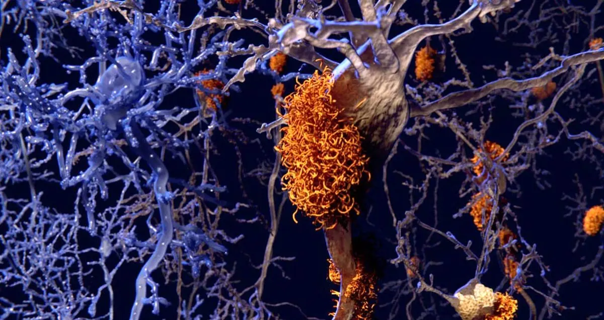 ارتباط بین متابولیسم و بی خوابی در بیماران مبتلا به آلزایمر