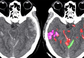 تشخیص سریع خونریزی مغزی به کمک هوش مصنوعی