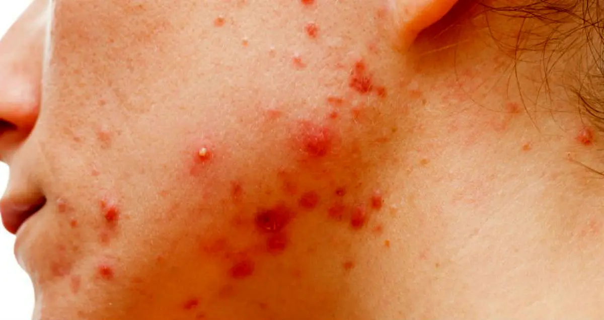 آیا آکنه درمان پذیر است؟