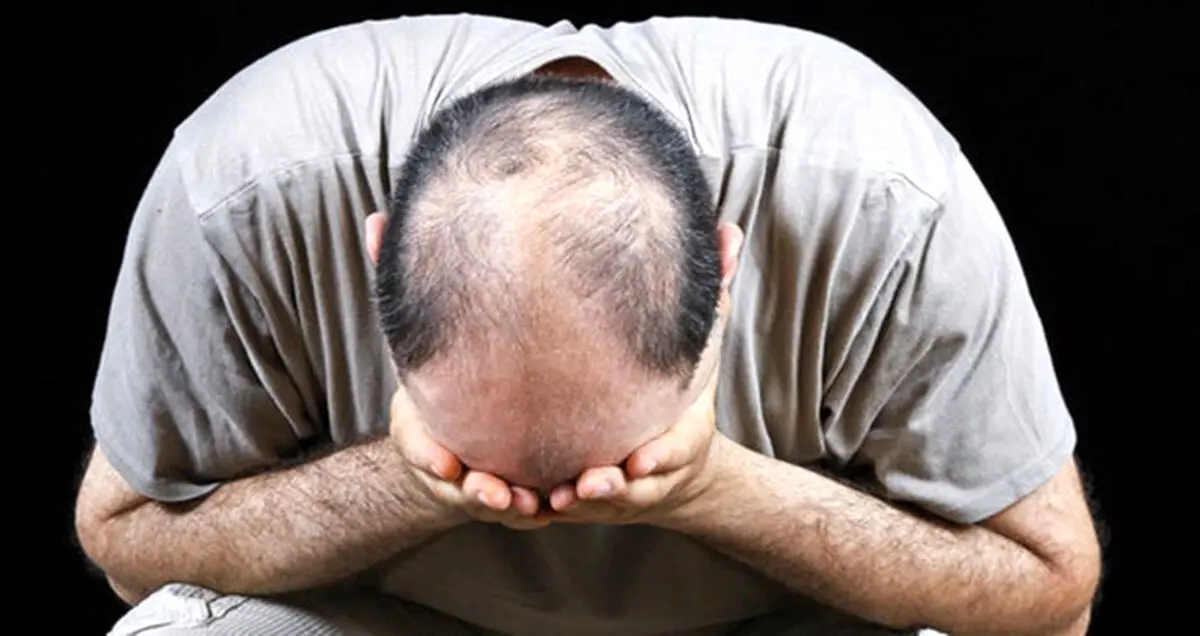 مراقب استفاده از داروی ضد ریزش موی Propecia باشید