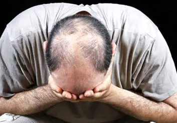 مراقب استفاده از داروی ضد ریزش موی Propecia باشید