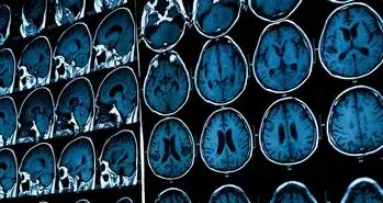 تشخیص افسردگی با تصویر MRI مغز