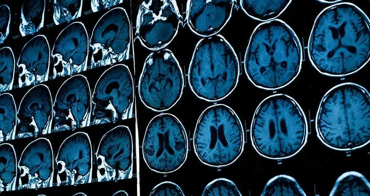 تشخیص افسردگی با تصویر MRI مغز