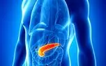 جلوگیری از پیشرفت دیابت نوع2، تنها با سوزاندن 