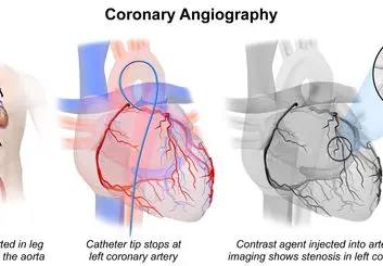 پیشرفته ترین روش های آنژیوگرافی در دنیای پزشکی امروز