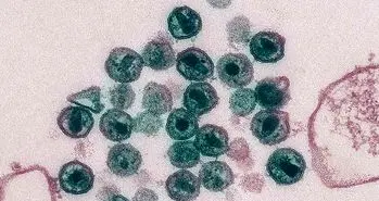 درمان ایدز با استفاده از پیوند سلول های بنیادی برای دومین بار!