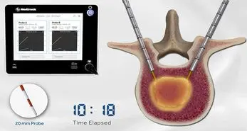 OsteoCool RF سیستم رفع تومور نخاعی جدید