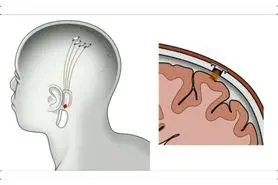 ایلان ماسک : پیوند چیپ هوش مصنوعی به مغز انسان طی یک سال آینده!