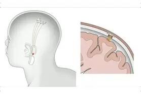 ایلان ماسک : پیوند چیپ هوش مصنوعی به مغز انسان طی یک سال آینده!