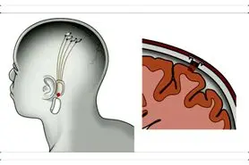 ایلان ماسک : پیوند چیپ هوش مصنوعی به مغز انسان طی یک سال آینده!