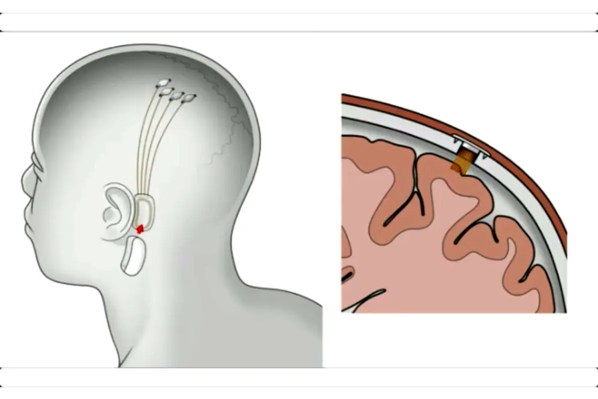 ایلان ماسک : پیوند چیپ هوش مصنوعی به مغز انسان طی یک سال آینده!