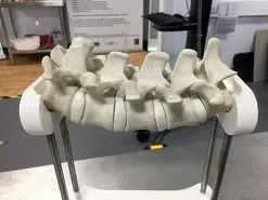 هوشمند شدن درمان ستون فقرات در ایران با سامانه جراحی رباتیک