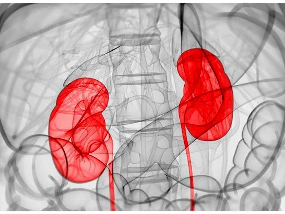 ساخت کلیه مصنوعی ؛ جایگزین دیالیز و پیوند کلیه
