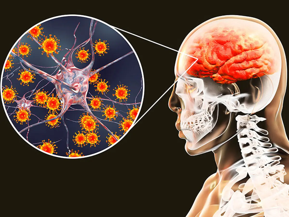 بازگشت آسیب مغزی ناشی از کرونا