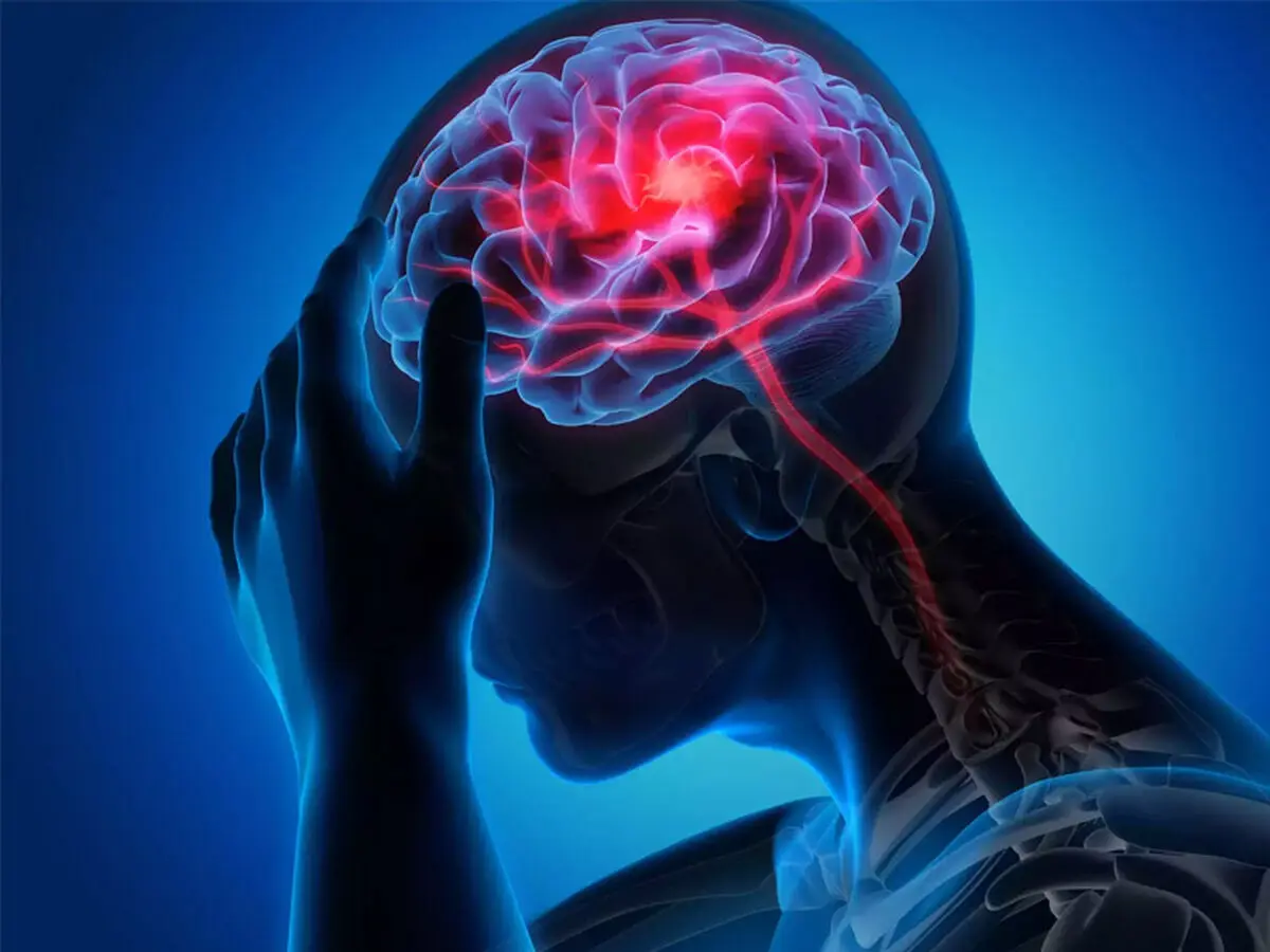 نقش تری گلیسیرید بالا در افزایش خطر سکته مغزی دوم