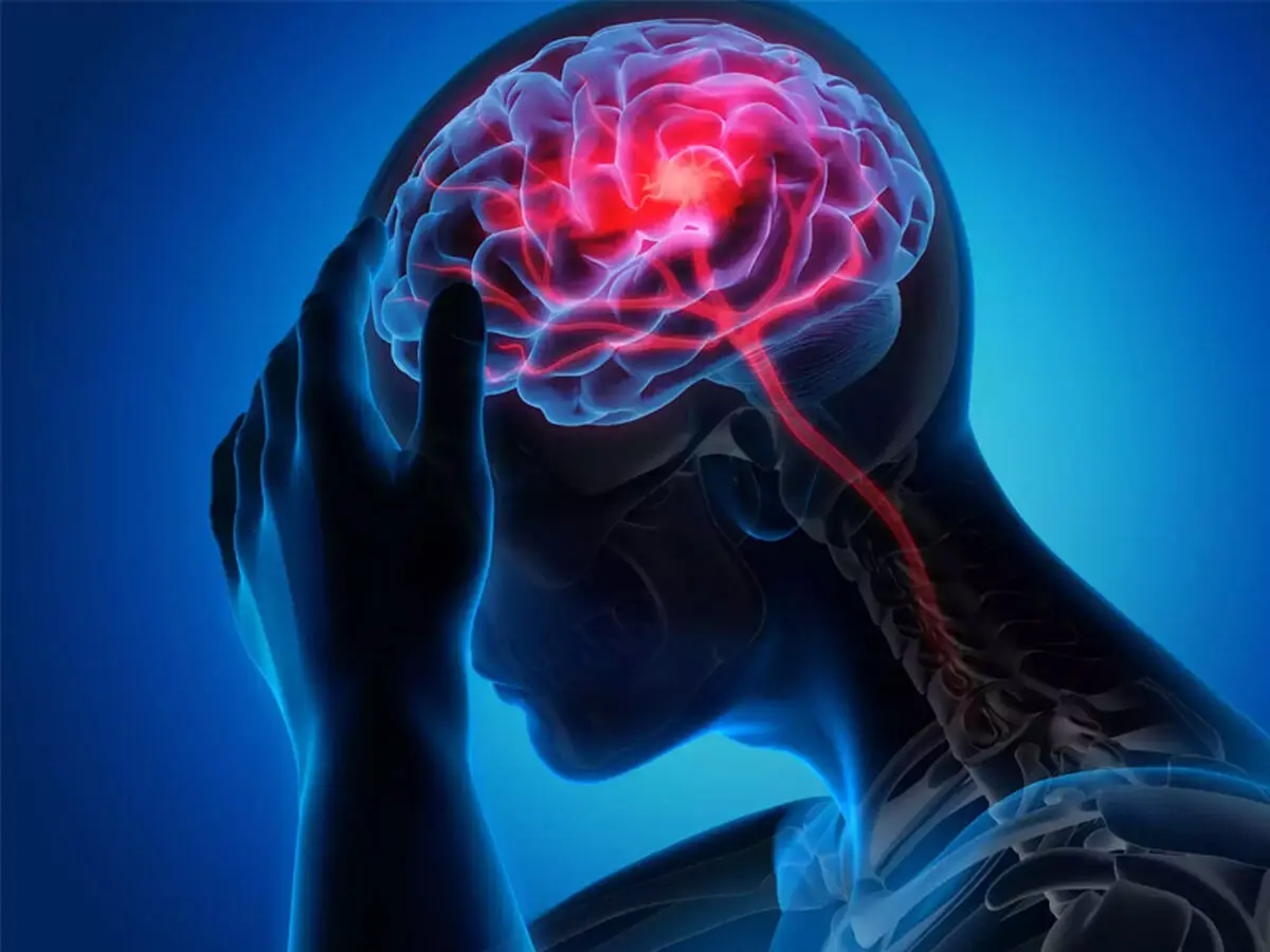 نقش تری گلیسیرید بالا در افزایش خطر سکته مغزی دوم