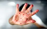 هشدار درباره کشندگی سرخک در کودکان دچار سوء تغذیه | لزوم واکسیناسیون گسترده