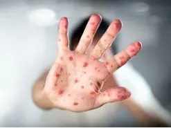 هشدار درباره کشندگی سرخک در کودکان دچار سوء تغذیه | لزوم واکسیناسیون گسترده