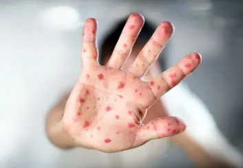 هشدار درباره کشندگی سرخک در کودکان دچار سوء تغذیه | لزوم واکسیناسیون گسترده