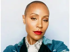 بیماری آلوپسی که همسر ویل اسمیت را دچار کرده چیست؟