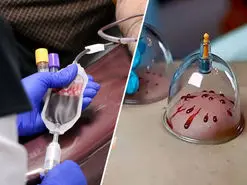 تفاوت حجامت با اهدای خون از لحاظ فرایند و اثرات درمانی