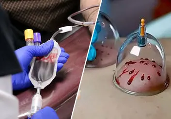 تفاوت حجامت با اهدای خون از لحاظ فرایند و اثرات درمانی