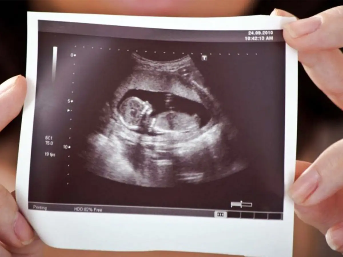 مدیرکل جمعیت وزارت بهداشت: غربالگری جنین ممنوع نشده است