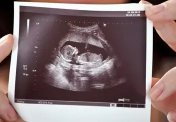 مدیرکل جمعیت وزارت بهداشت: غربالگری جنین ممنوع نشده است