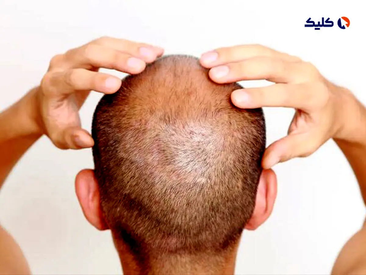 راه حلی امیدوارکننده برای درمان طاسی