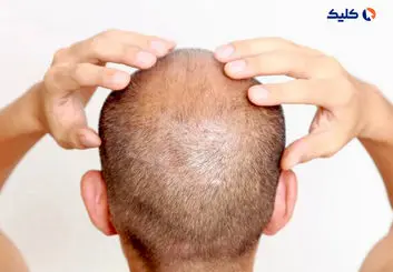 راه حلی امیدوارکننده برای درمان طاسی