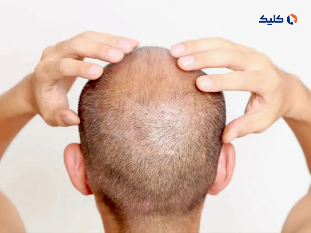 راه حلی امیدوارکننده برای درمان طاسی