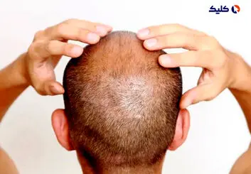 راه حلی امیدوارکننده برای درمان طاسی