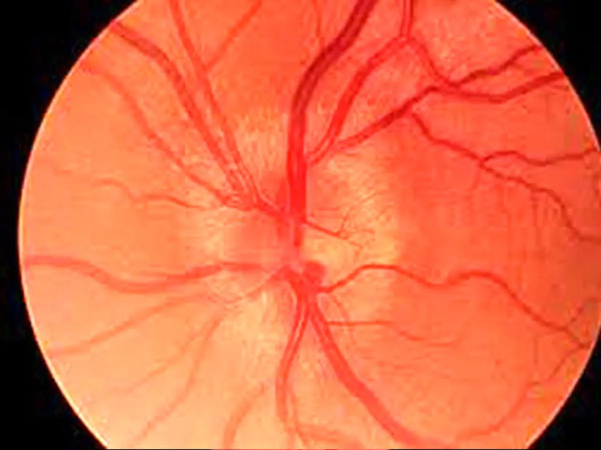 استفاده از سلول‌های پیش‌ساز عصبی برای حفاظت از عصب بینایی