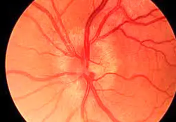 استفاده از سلول‌های پیش‌ساز عصبی برای حفاظت از عصب بینایی