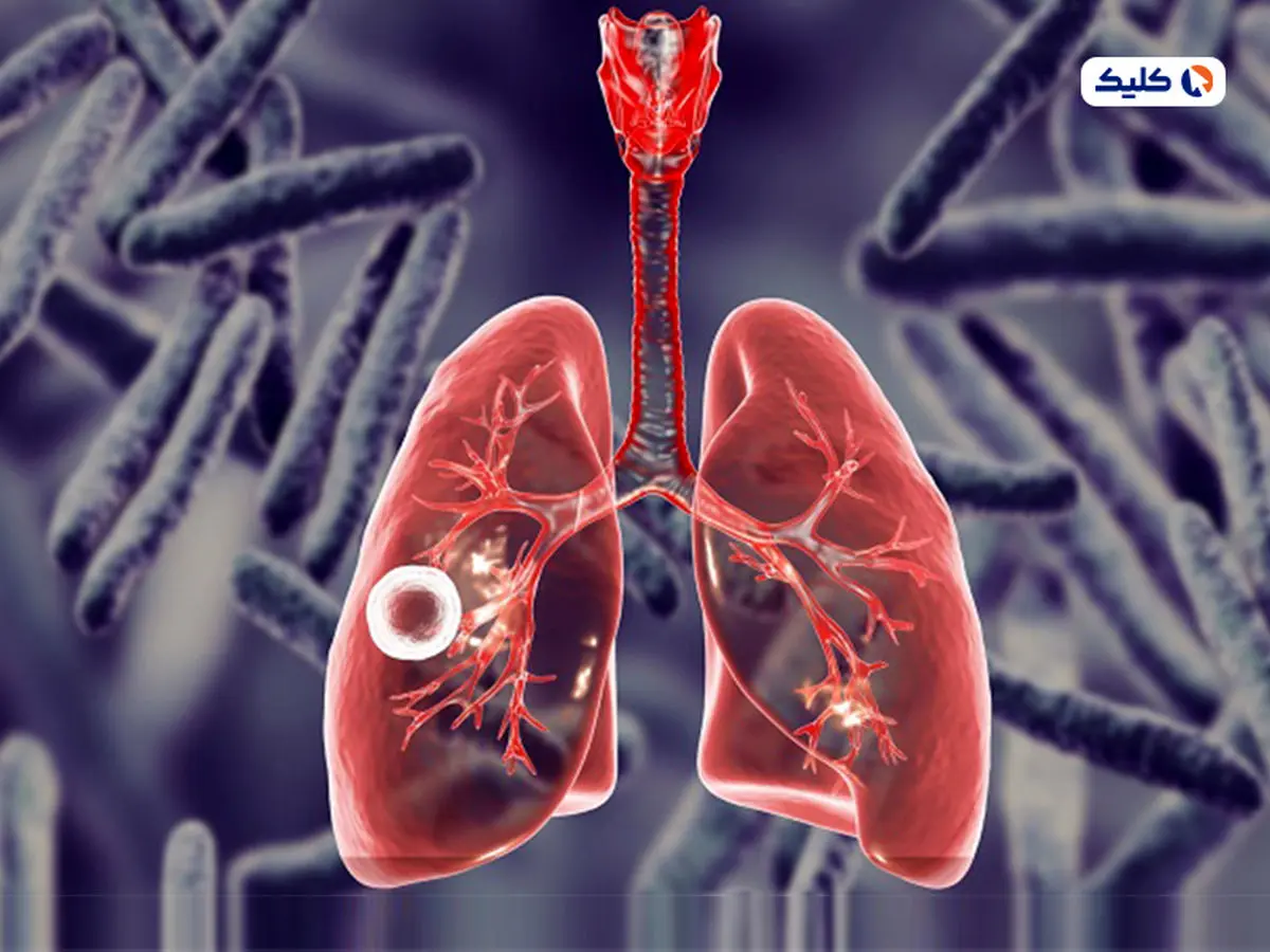 یکی از کشنده‌ترین بیماری‌های جهان بار دیگر در حال افزایش است