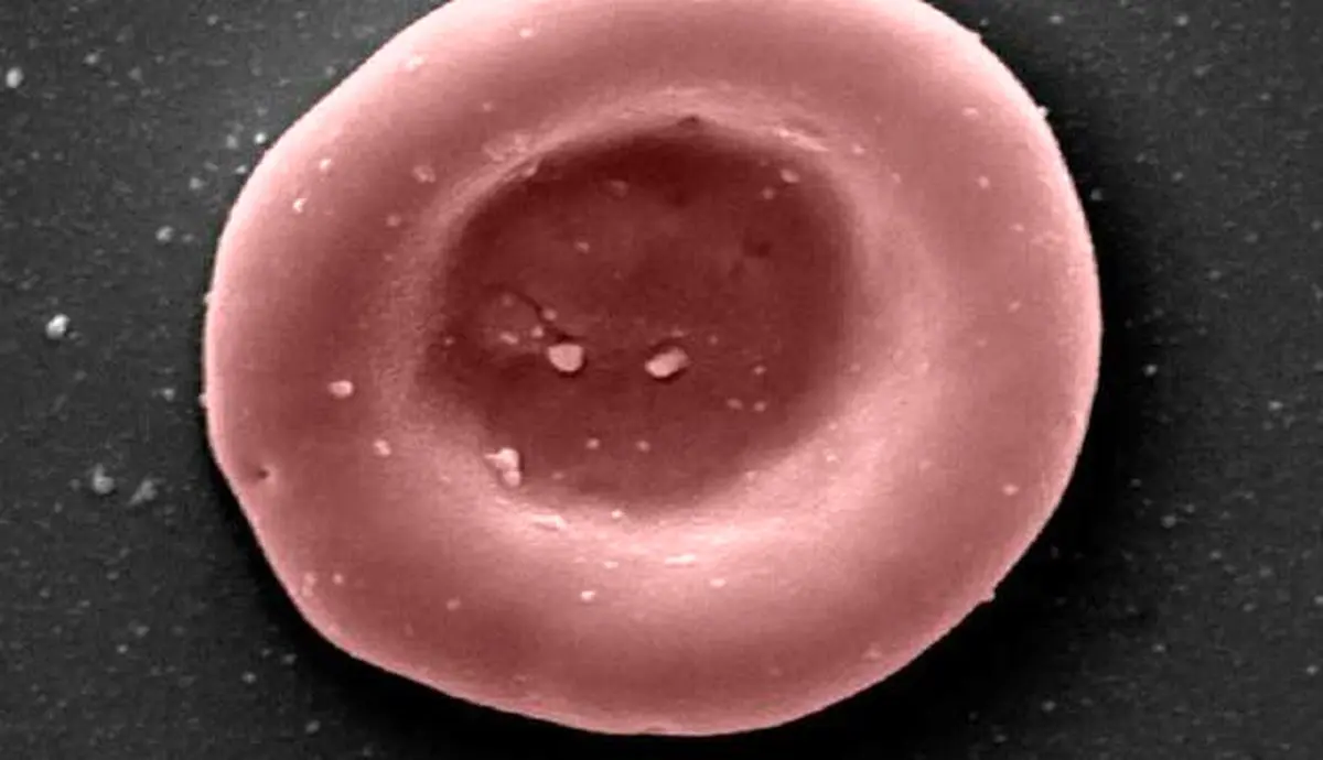 نخستین انتقال خون با سلول‌های پرورش‌یافته در آزمایشگاه انجام شد