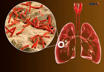 درمان کامل سل در دو ماه