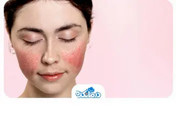 رزاسه چیست؟ علت، علائم و راه‌کارهای درمانی آن