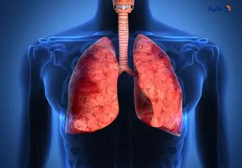 محافظت در برابر آسم آلرژیک