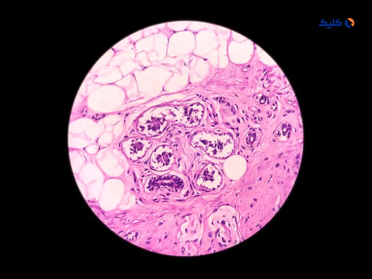 پوست مصنوعی درمانی برای سرطان پوست