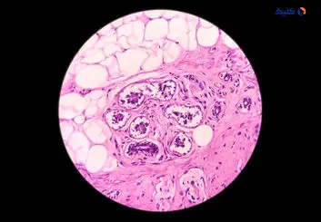 پوست مصنوعی درمانی برای سرطان پوست