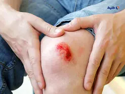 درمان زخم ها با الکتریسیته